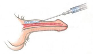 Objemová injekcia s kyselinou hyalurónovou do penisu